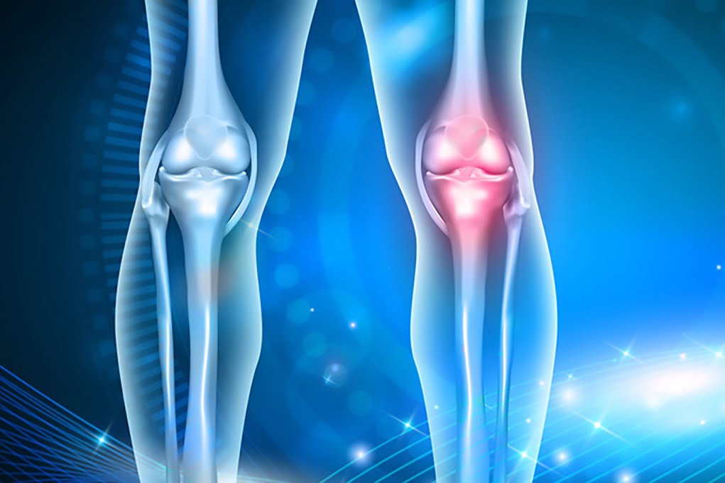 Reduce Arthritis Pain and Reduce NSAIDs with Omega-3