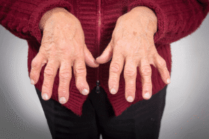 Joint pain - rheumatoid arthritis - older lady's hands showing swollen joints